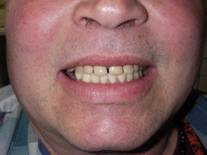 Smile Reconstruction After